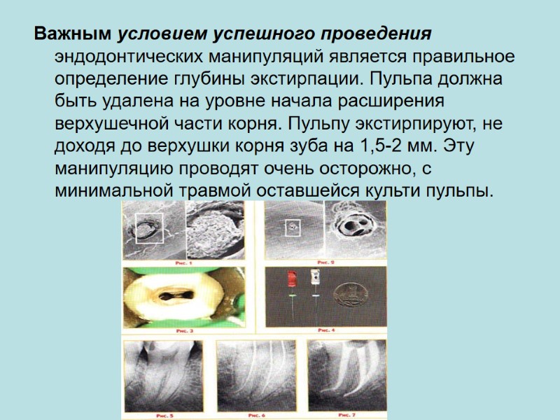 Важным условием успешного проведения эндодонтических манипуляций является правильное определение глубины экстирпации. Пульпа должна быть